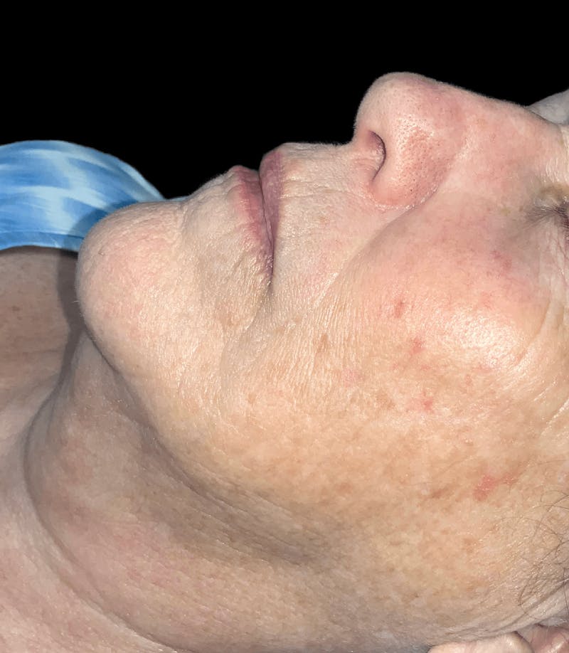 Skin Pigment Removal Before & After Gallery - Patient 169943773 - Image 2