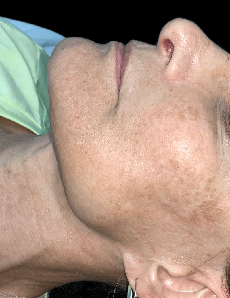 Skin Pigment Removal Before & After Gallery - Patient 169943800 - Image 1