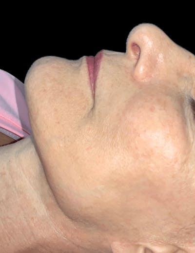 Skin Pigment Removal Before & After Gallery - Patient 169943800 - Image 2