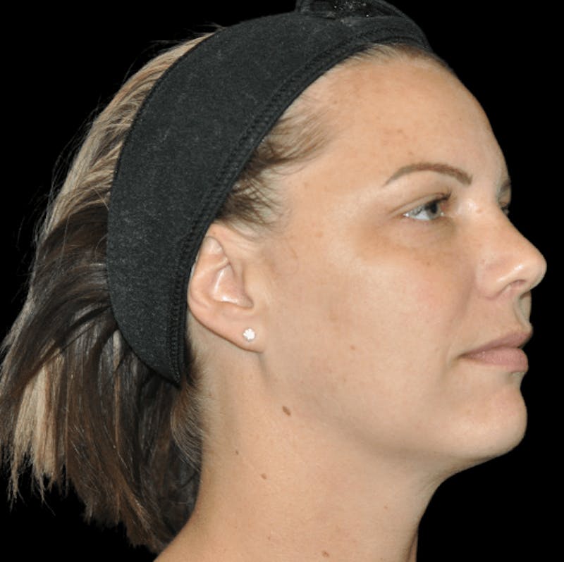 Skin Pigment Removal Before & After Gallery - Patient 169943825 - Image 2