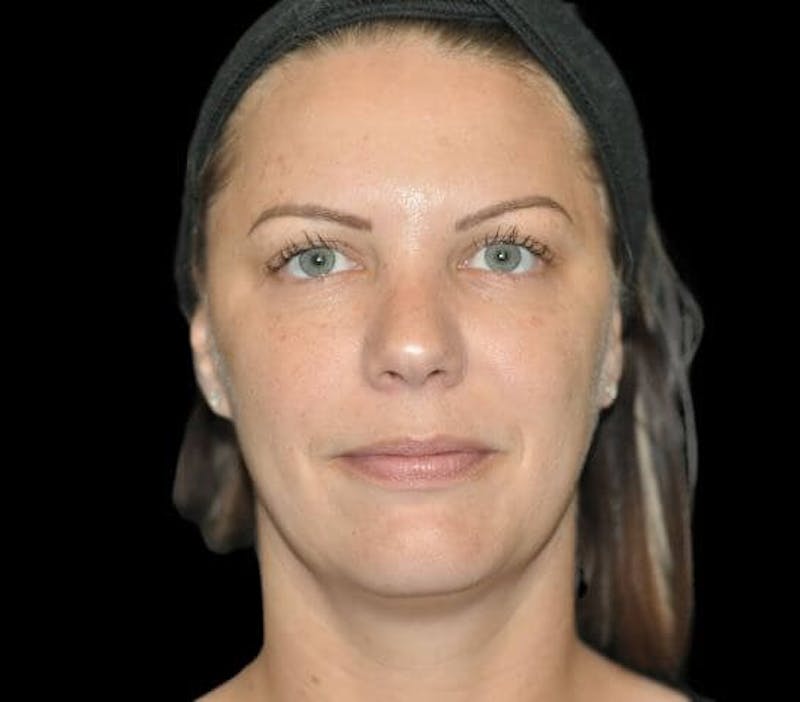 Skin Pigment Removal Before & After Gallery - Patient 169943825 - Image 4