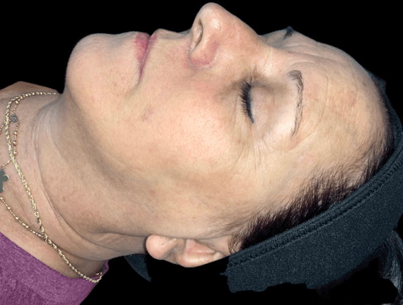 ELLUMINATE WITH IPL Before & After Gallery - Patient 304431 - Image 2