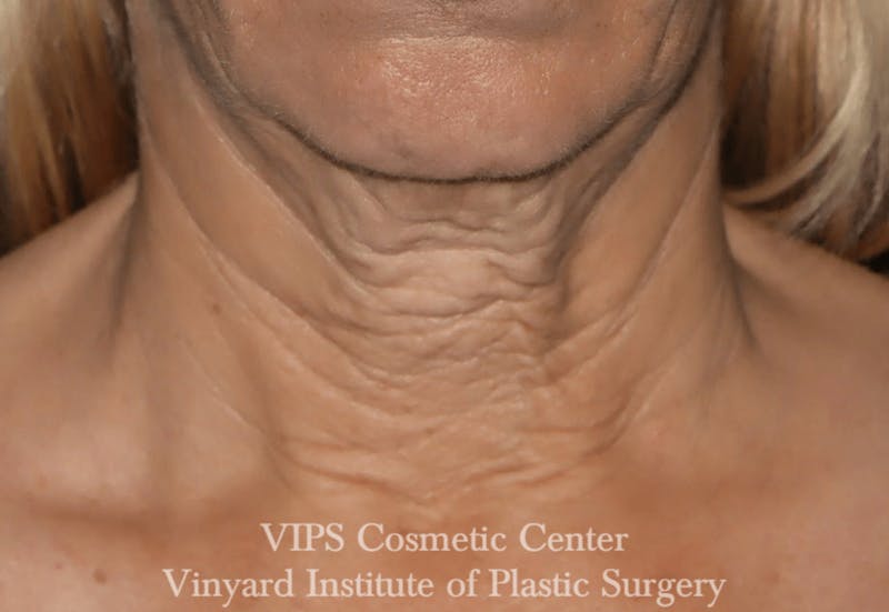 RF Microneedling Morpheus 8 Before & After Gallery - Patient 169944574 - Image 1
