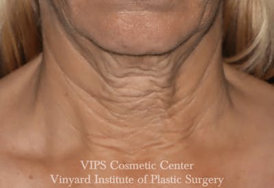 RF Microneedling Morpheus 8 Before & After Gallery - Patient 169944574 - Image 1