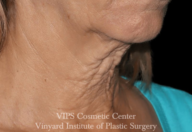 RF Microneedling Morpheus 8 Before & After Gallery - Patient 169944574 - Image 3