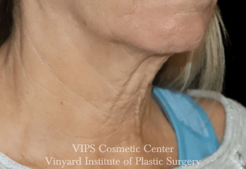 RF Microneedling Morpheus 8 Before & After Gallery - Patient 169944574 - Image 4