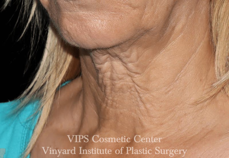 RF Microneedling Morpheus 8 Before & After Gallery - Patient 169944574 - Image 5