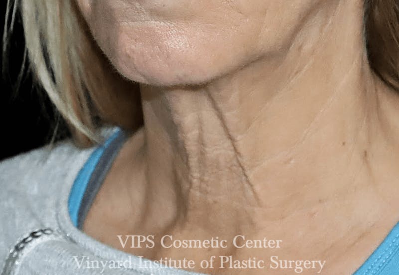 RF Microneedling Morpheus 8 Before & After Gallery - Patient 169944574 - Image 6