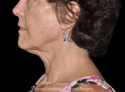 RF Microneedling Morpheus 8 Before & After Gallery - Patient 169944595 - Image 1