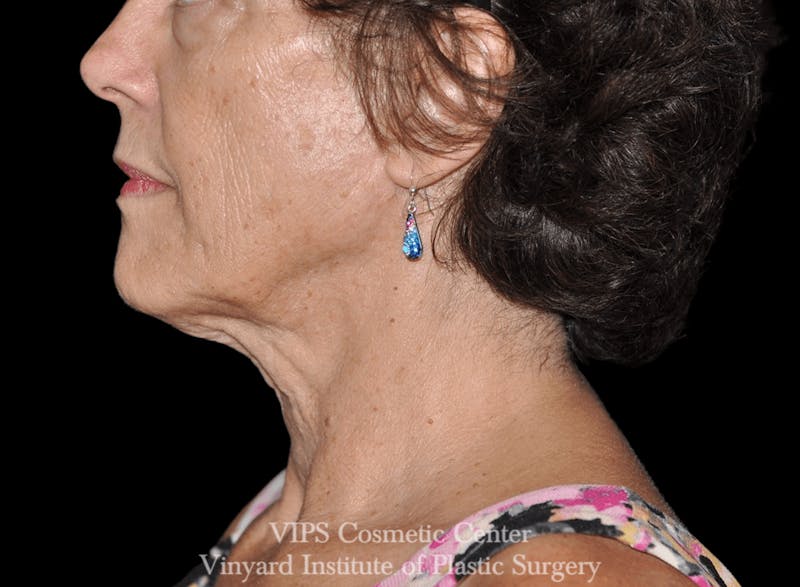 RF Microneedling Morpheus 8 Before & After Gallery - Patient 169944595 - Image 1