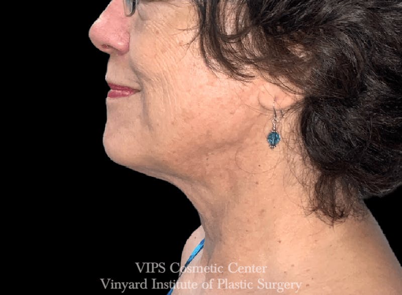 RF Microneedling Morpheus 8 Before & After Gallery - Patient 169944595 - Image 2