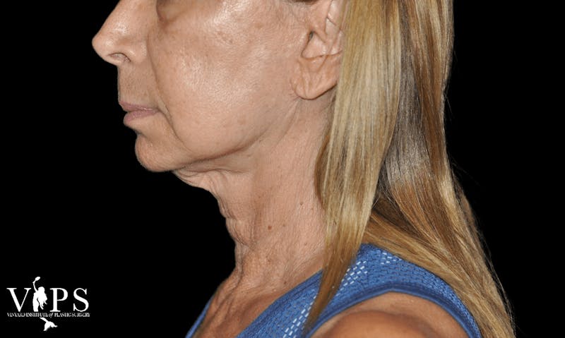 RF Microneedling Morpheus 8 Before & After Gallery - Patient 169944642 - Image 1