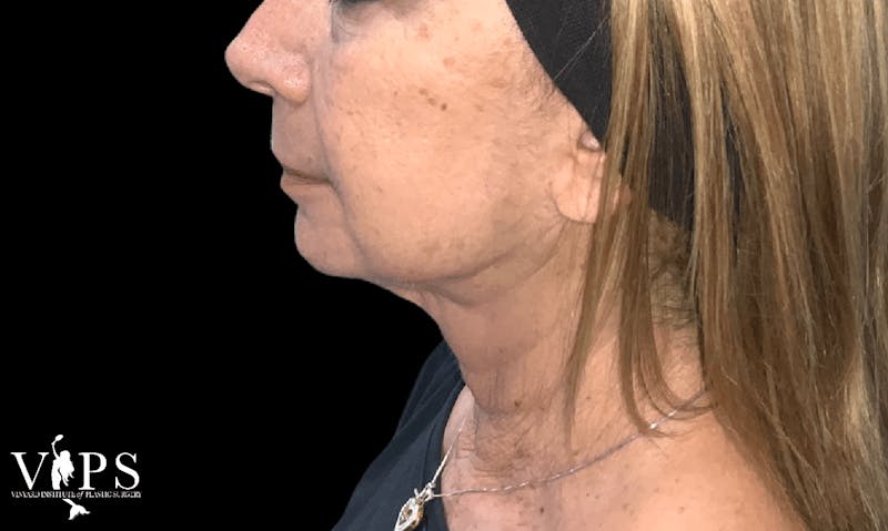 RF Microneedling Morpheus 8 Before & After Gallery - Patient 169944642 - Image 2