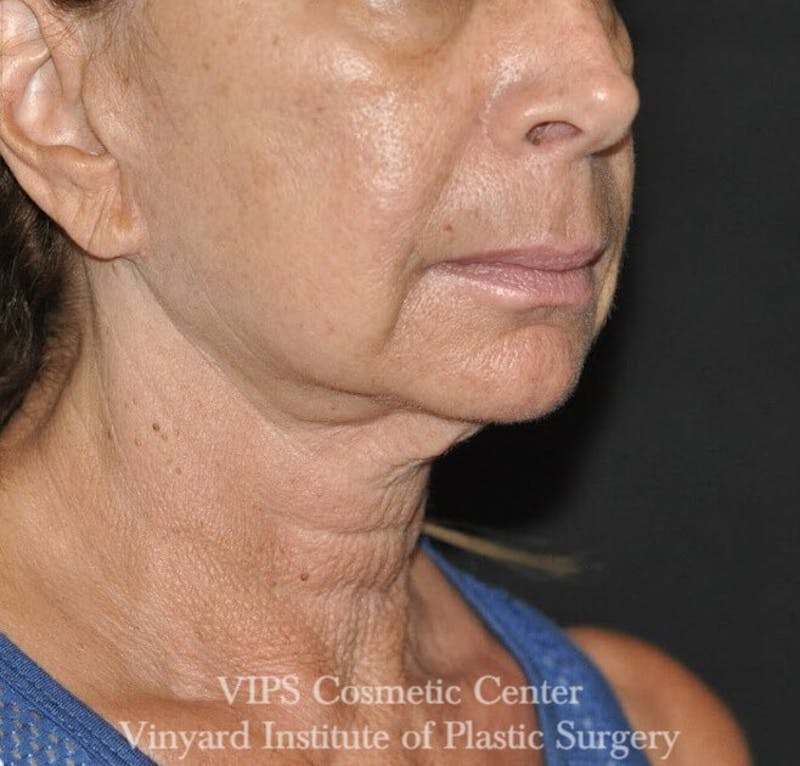RF Microneedling Morpheus 8 Before & After Gallery - Patient 169944642 - Image 3