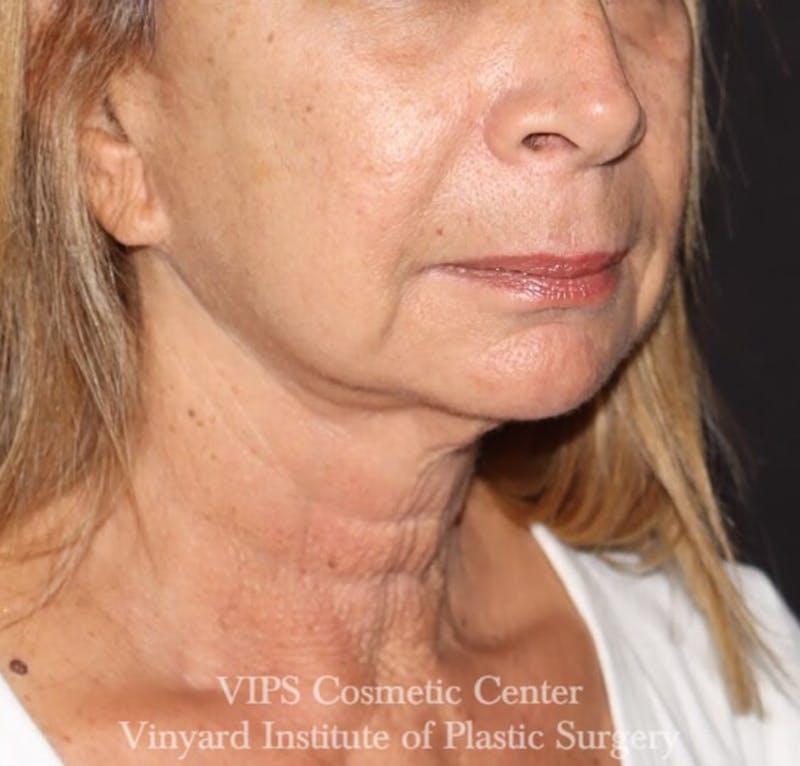 RF Microneedling Morpheus 8 Before & After Gallery - Patient 169944642 - Image 4