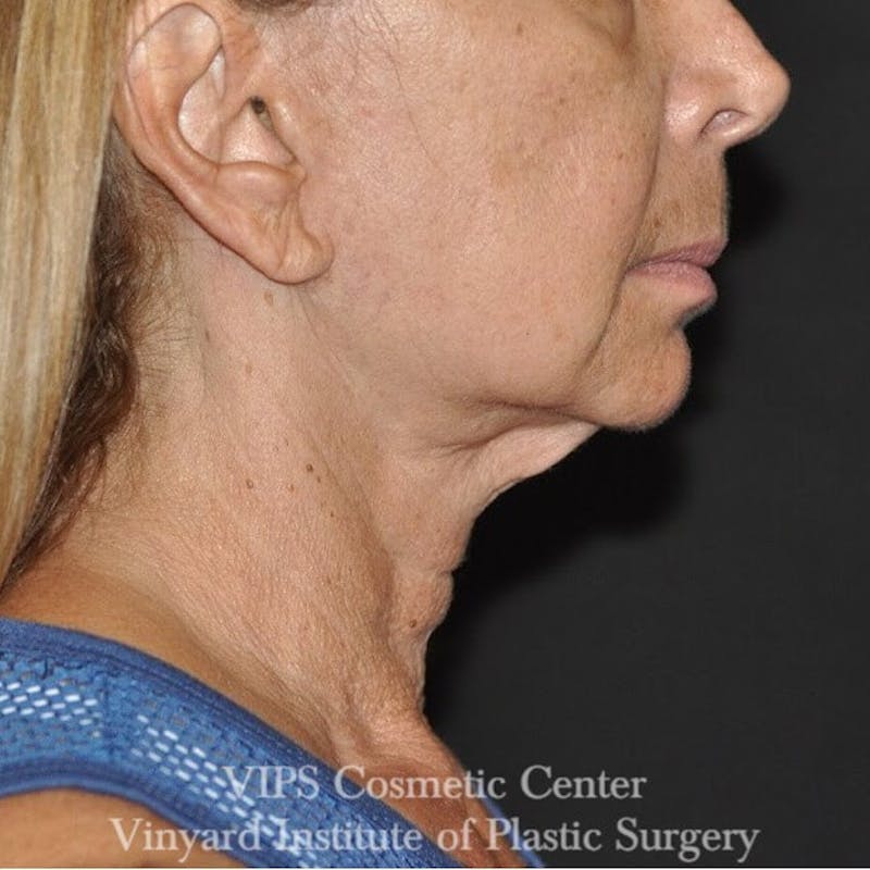 RF Microneedling Morpheus 8 Before & After Gallery - Patient 169944642 - Image 5