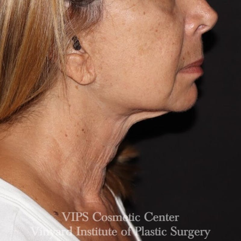 RF Microneedling Morpheus 8 Before & After Gallery - Patient 169944642 - Image 6