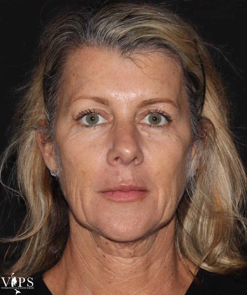 RF Microneedling Morpheus 8 Before & After Gallery - Patient 169944689 - Image 1