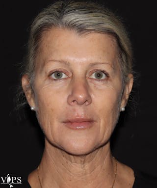 RF Microneedling Morpheus 8 Before & After Gallery - Patient 169944689 - Image 2