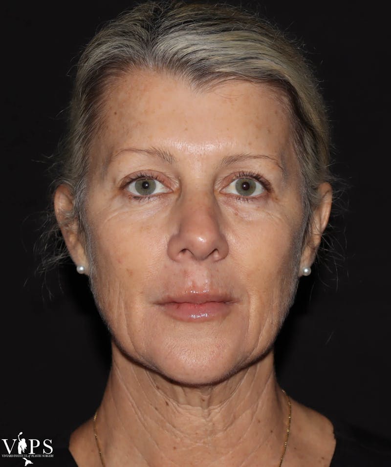 RF Microneedling Morpheus 8 Before & After Gallery - Patient 169944689 - Image 2