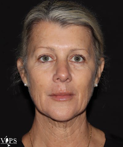 Morpheus8 RF Microneedling Before & After Gallery - Patient 169944689 - Image 2