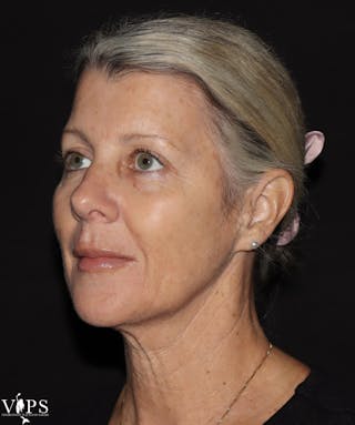 RF Microneedling Morpheus 8 Before & After Gallery - Patient 169944689 - Image 4