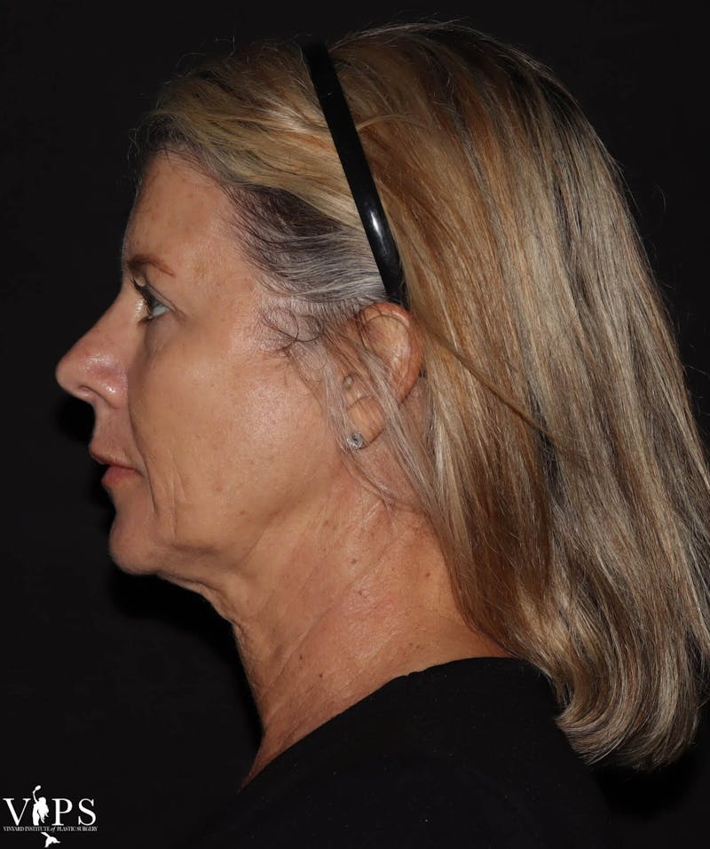 RF Microneedling Morpheus 8 Before & After Gallery - Patient 169944689 - Image 5