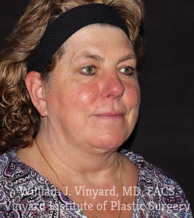 Morpheus8 RF Microneedling Before & After Gallery - Patient 169944730 - Image 2