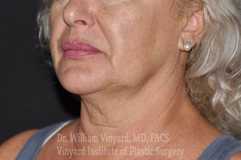 RF Microneedling Morpheus 8 Before & After Gallery - Patient 169944762 - Image 1