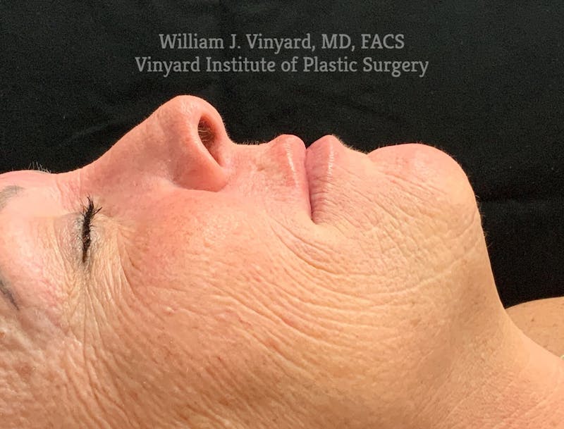 Laser Skin Resurfacing Before & After Gallery - Patient 169945581 - Image 1
