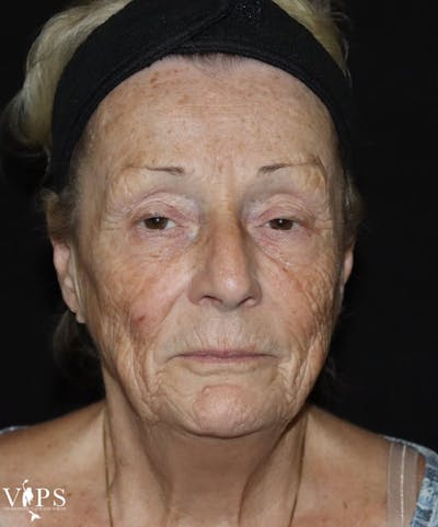Laser Skin Resurfacing Before & After Gallery - Patient 169945609 - Image 1