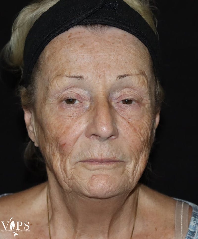 Laser Skin Resurfacing Before & After Gallery - Patient 169945609 - Image 1