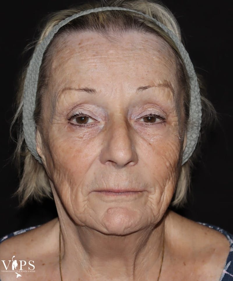 Laser Skin Resurfacing Before & After Gallery - Patient 169945609 - Image 2