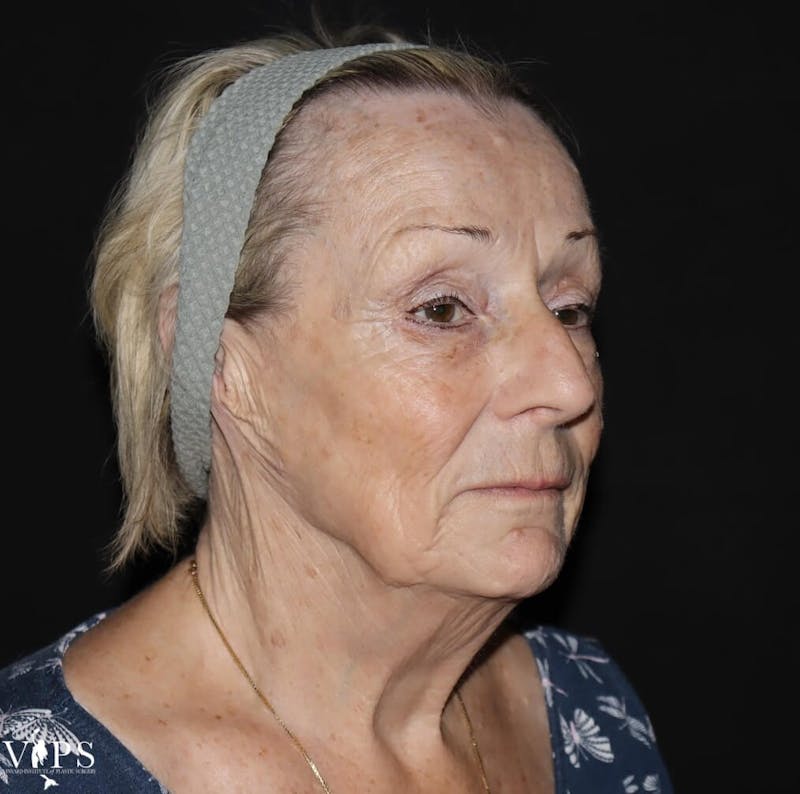 Laser Skin Resurfacing Before & After Gallery - Patient 169945609 - Image 4