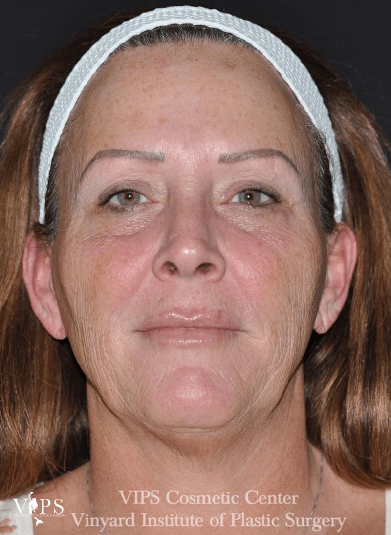 Laser Skin Resurfacing Before & After Gallery - Patient 169945627 - Image 1