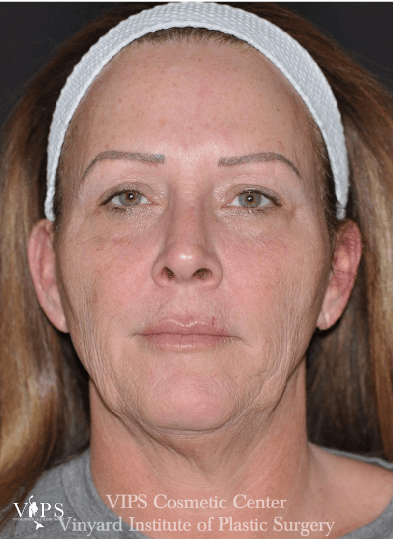 Laser Skin Resurfacing Before & After Gallery - Patient 169945627 - Image 2