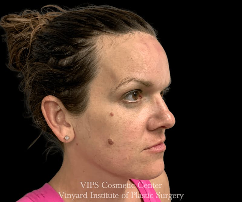 Laser Skin Resurfacing Before & After Gallery - Patient 169945677 - Image 1