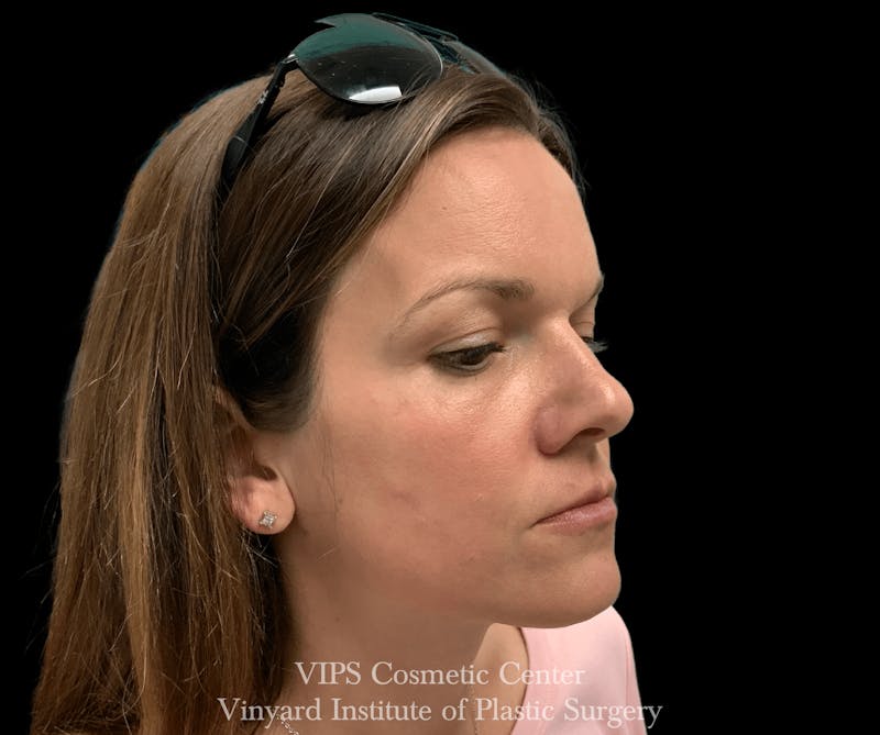 Laser Skin Resurfacing Before & After Gallery - Patient 169945677 - Image 2