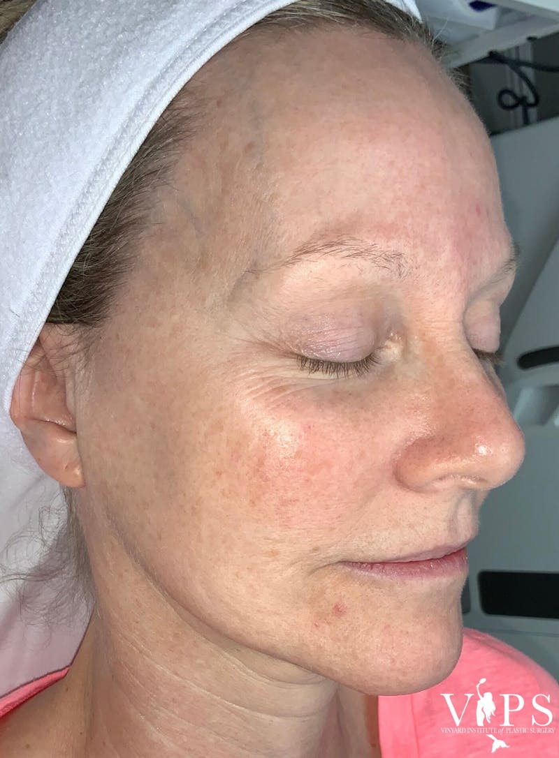 Laser Skin Resurfacing Before & After Gallery - Patient 169945722 - Image 1