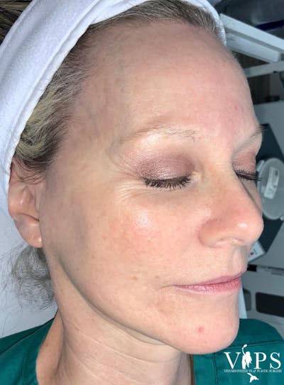 Laser Skin Resurfacing Before & After Gallery - Patient 169945722 - Image 2