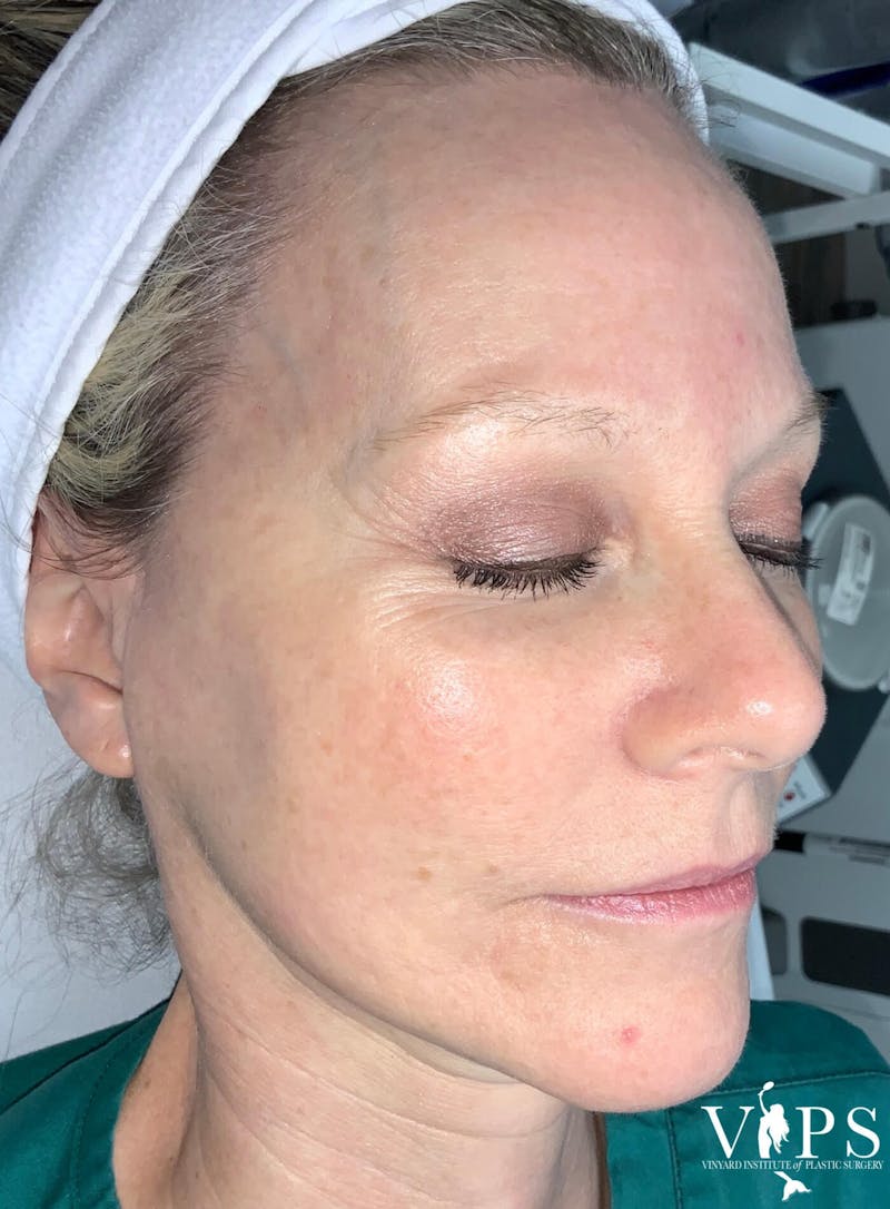 Laser Skin Resurfacing Before & After Gallery - Patient 169945722 - Image 2