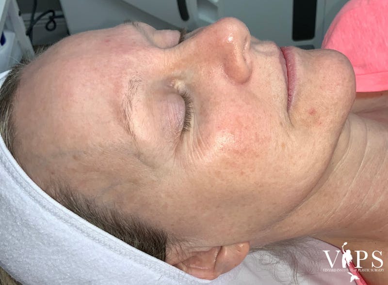 Laser Skin Resurfacing Before & After Gallery - Patient 169945722 - Image 3
