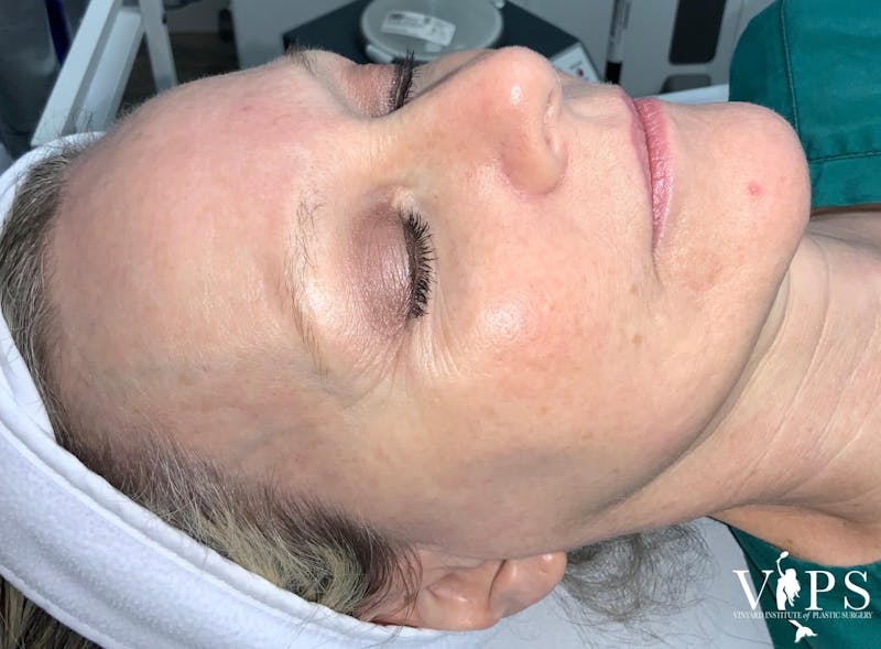 Laser Skin Resurfacing Before & After Gallery - Patient 169945722 - Image 4