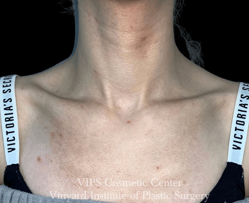 Laser Skin Resurfacing Before & After Gallery - Patient 169945755 - Image 1