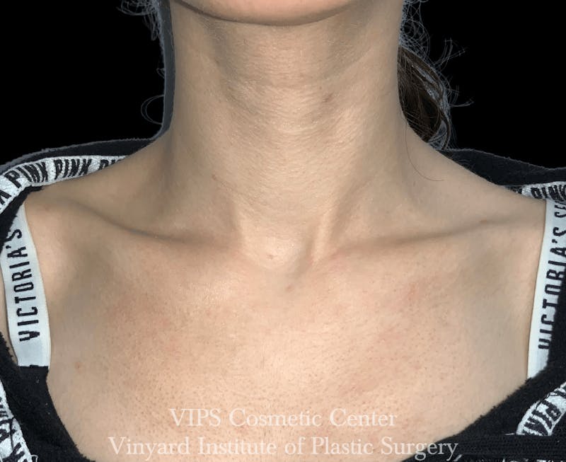 Laser Skin Resurfacing Before & After Gallery - Patient 169945755 - Image 2