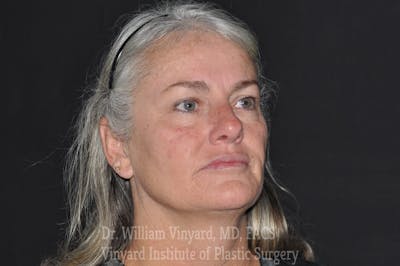 Laser Skin Resurfacing Before & After Gallery - Patient 169945829 - Image 1