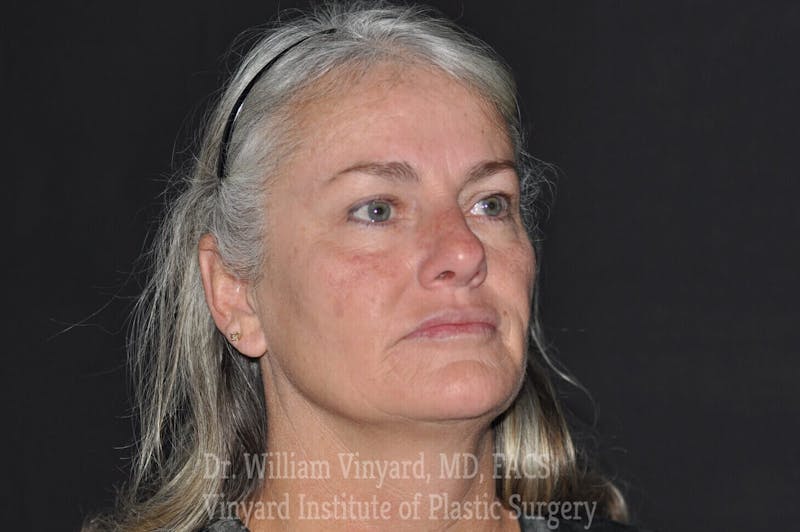Laser Skin Resurfacing Before & After Gallery - Patient 169945829 - Image 1