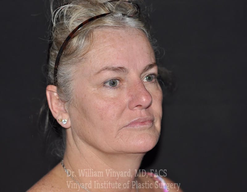 Laser Skin Resurfacing Before & After Gallery - Patient 169945829 - Image 2