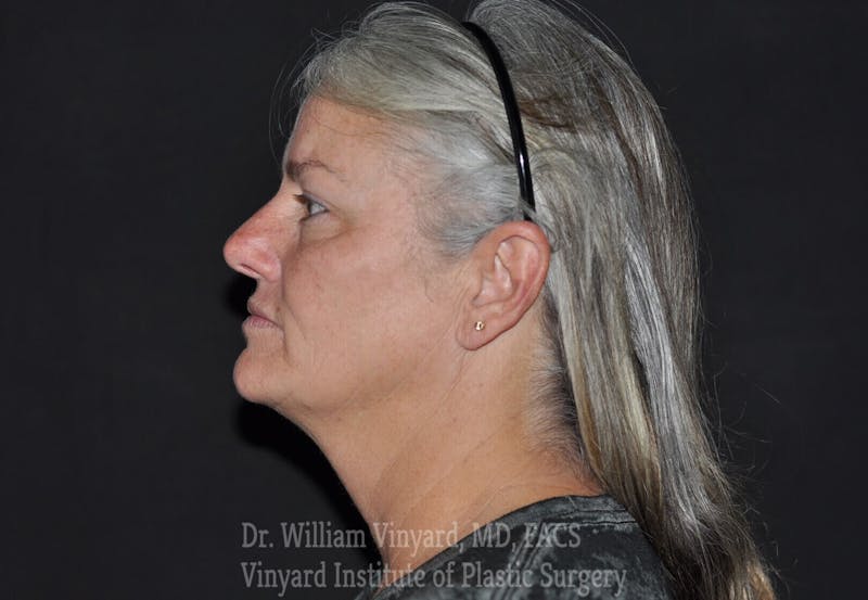 Laser Skin Resurfacing Before & After Gallery - Patient 169945829 - Image 3