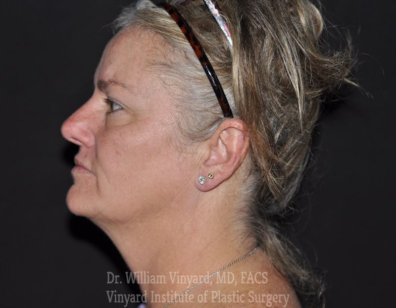 Laser Skin Resurfacing Before & After Gallery - Patient 169945829 - Image 4